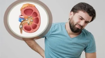 حصوات الكلى.. اكتشف أفضل المشروبات اليومية للوقاية منها وحماية صحة كليتك